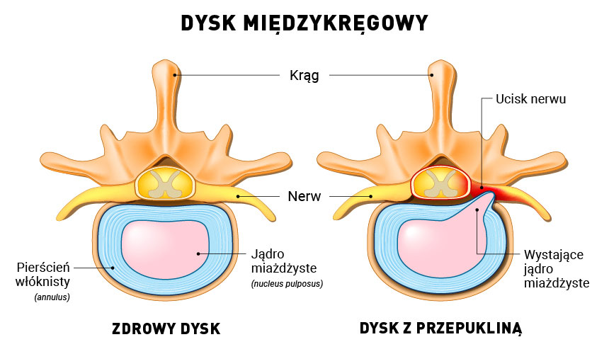 Schemat przepukliny dysku międzykręgowego